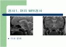 Cushing Syndrome PBL 발표자료 11페이지