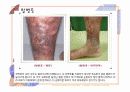하지정맥류 질환 정리 32페이지