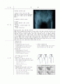 Fracture of femur neck (대퇴 경부 골절) 4페이지