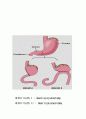subtotal gastrectomy 12페이지
