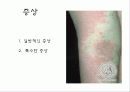 자가 면역 질환 건선 15페이지