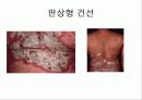 자가 면역 질환 건선 18페이지