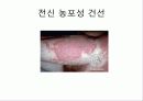 자가 면역 질환 건선 22페이지