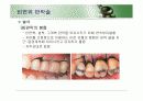 치주판막술식(periodontal flap) 32페이지
