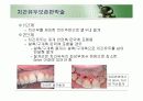 치주판막술식(periodontal flap) 42페이지