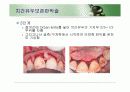 치주판막술식(periodontal flap) 43페이지
