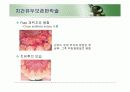 치주판막술식(periodontal flap) 44페이지