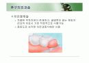치주판막술식(periodontal flap) 47페이지