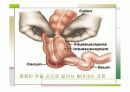 장중첩증 케이스스터디  17페이지