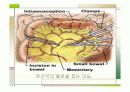 장중첩증 케이스스터디  19페이지