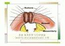 장중첩증 케이스스터디  20페이지