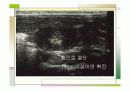 특발성비후성유문협착증 12페이지