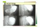 특발성비후성유문협착증 13페이지