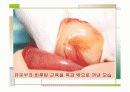 특발성비후성유문협착증 21페이지