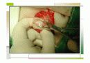 특발성비후성유문협착증 23페이지