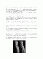 PDPH 경막외 혈액 봉합술(Epidural blood patch) 10페이지