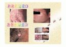 전염성 콘딜로마 ppt 자료 4페이지