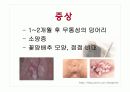 전염성 콘딜로마 ppt 자료 7페이지