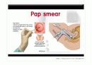 전염성 콘딜로마 ppt 자료 9페이지