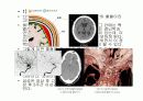 경막하출혈(SDH , Traumatic Subdural Hemorrhage ) 4페이지
