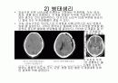 경막하출혈(SDH , Traumatic Subdural Hemorrhage ) 5페이지