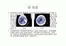 경막하출혈(SDH , Traumatic Subdural Hemorrhage ) 10페이지