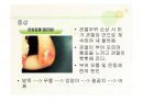 혈우병ppt 10페이지