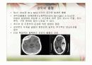 뇌졸중의 모든것(원인 증상 진단 치료 etc.) 14페이지