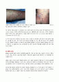 메시실린 내성 황색 포도상구균(Methicillin-resistant Staphylococcus aureus, MRSA) 3페이지
