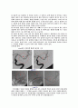 Cerebral Infarction(뇌경색) 10페이지