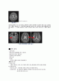 Cerebral Infarction(뇌경색) 11페이지