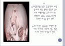 뇌내출혈 ICH 38페이지