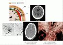 경막하출혈(SDH , Traumatic Subdural Hemorrhage )컨퍼런스 6페이지