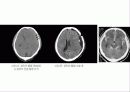 경막하출혈(SDH , Traumatic Subdural Hemorrhage )컨퍼런스 9페이지