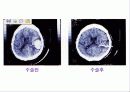 경막하출혈(SDH , Traumatic Subdural Hemorrhage )컨퍼런스 16페이지
