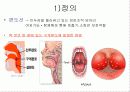 아동 간호학 - 편도선염 4페이지
