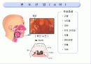아동 간호학 - 편도선염 5페이지