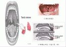 아동 간호학 - 편도선염 11페이지