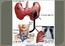 Thyroid gand(갑상선 암)관련 PPT자료입니다. 참고하세요 18페이지