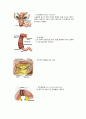 장중첩증 Intussusception 5페이지