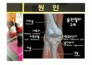 경골골절 문헌고찰/간호사정 ppt (사진많음)♥ 3페이지