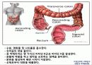 선천성 거대결장 10페이지