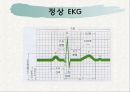 심근경색증 파워포인트 7페이지