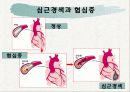 심근경색증 파워포인트 25페이지