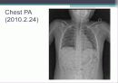  urachal cyst 13페이지
