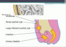  urachal cyst 31페이지