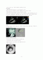 대동맥 박리 aortic dissection 10페이지