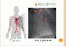 심근경색( Myocardial Infarction. MI ) CASE 16페이지