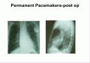 pacemaker 38페이지