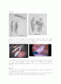 수술실, 기흉, 문헌고찰, 간호진단 6페이지